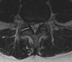 L45 Posterolateral Disc